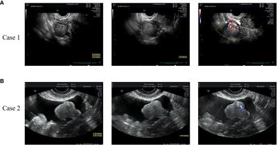 Ovarian steroid cell tumors, not otherwise specified: three case reports and literature review